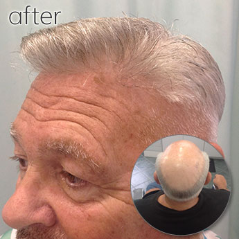 Before and After Image of Elderly Man